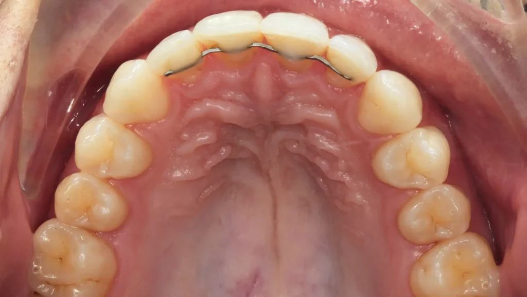 Ortodoncia antes y después desalineación