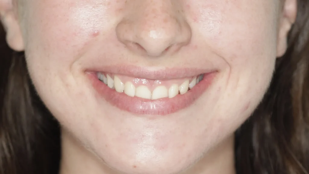 Ortodoncia antes y después mordida cruzada