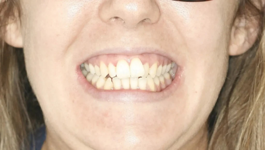 Ortodoncia antes y después Maloclusión