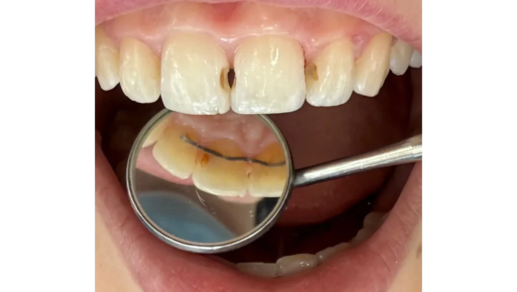 Restauración de caries