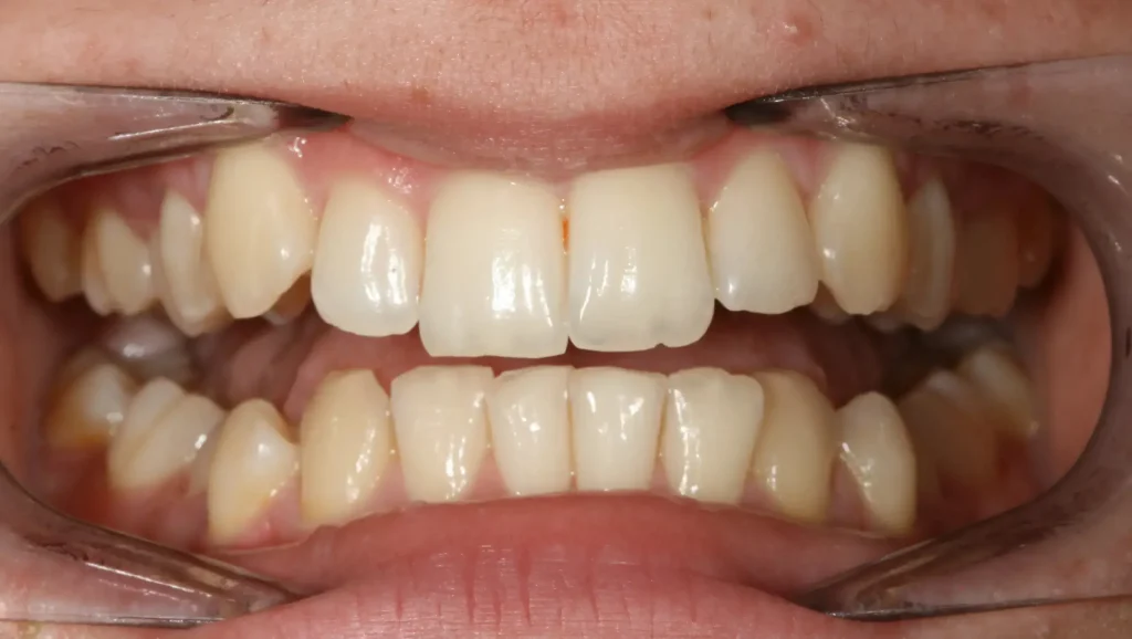 Ortodoncia antes y después desalineación