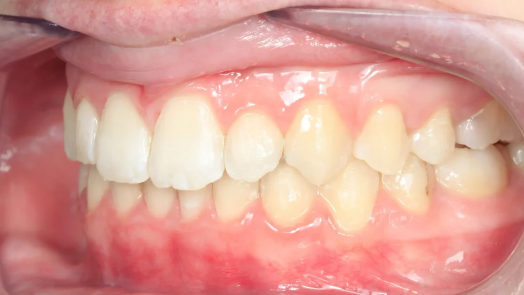 Caso 1 mordida cruzada