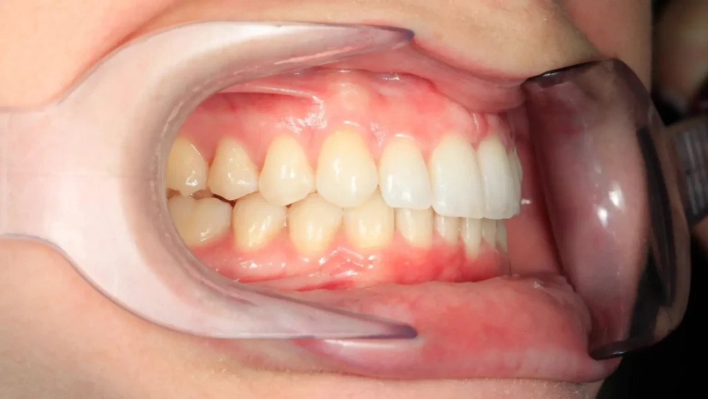 Ortodoncia antes y después desalineación
