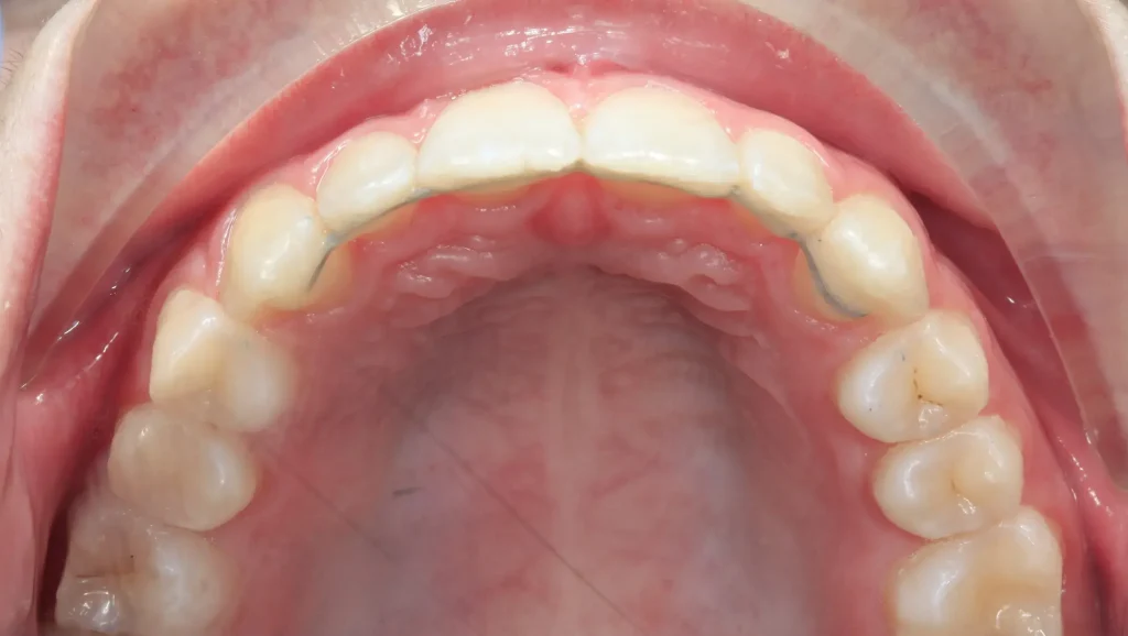 Caso 1 mordida cruzada