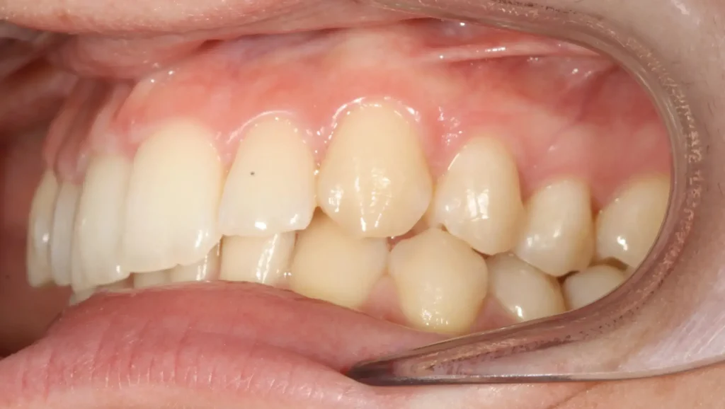 Ortodoncia antes y después desalineación