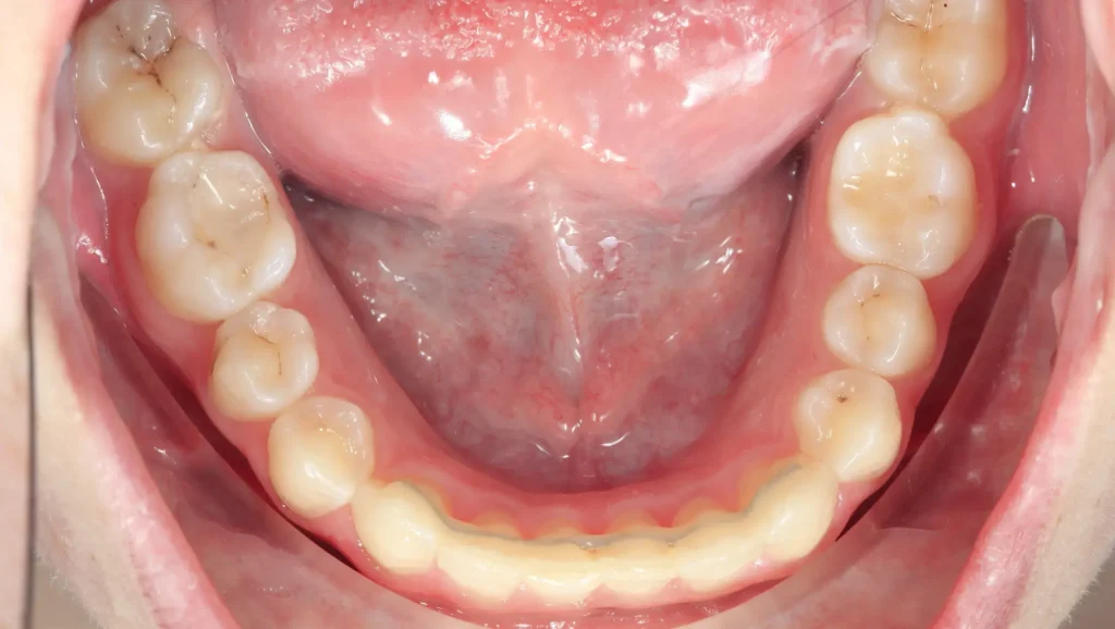 Caso 1 mordida cruzada