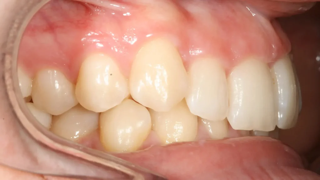 Ortodoncia antes y después desalineación