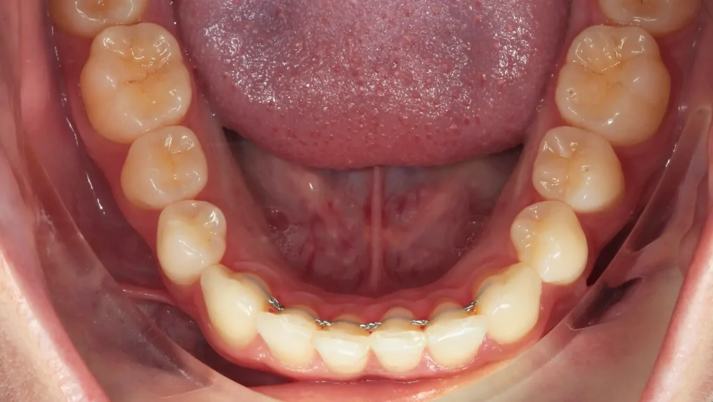 Ortodoncia antes y después desalineación