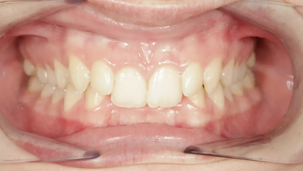 Ortodoncia antes y después mordida cruzada