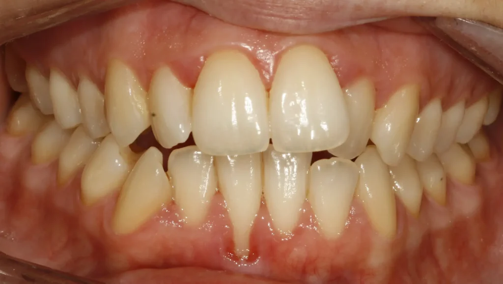 Ortodoncia antes y después Maloclusión