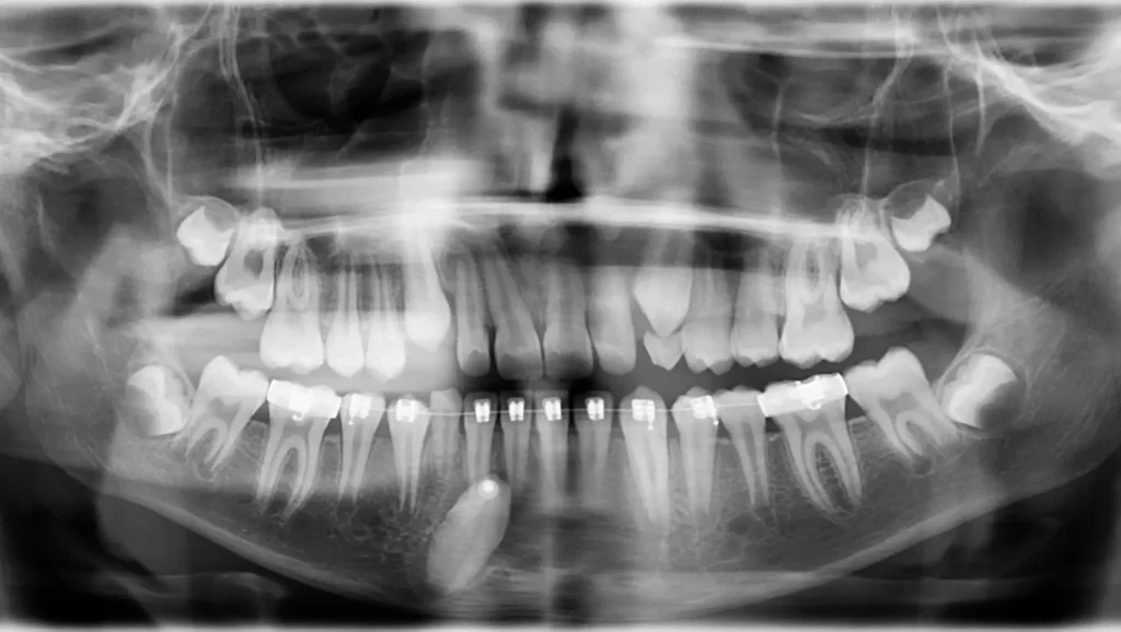 Ortodoncia antes y después canino inferior impactado