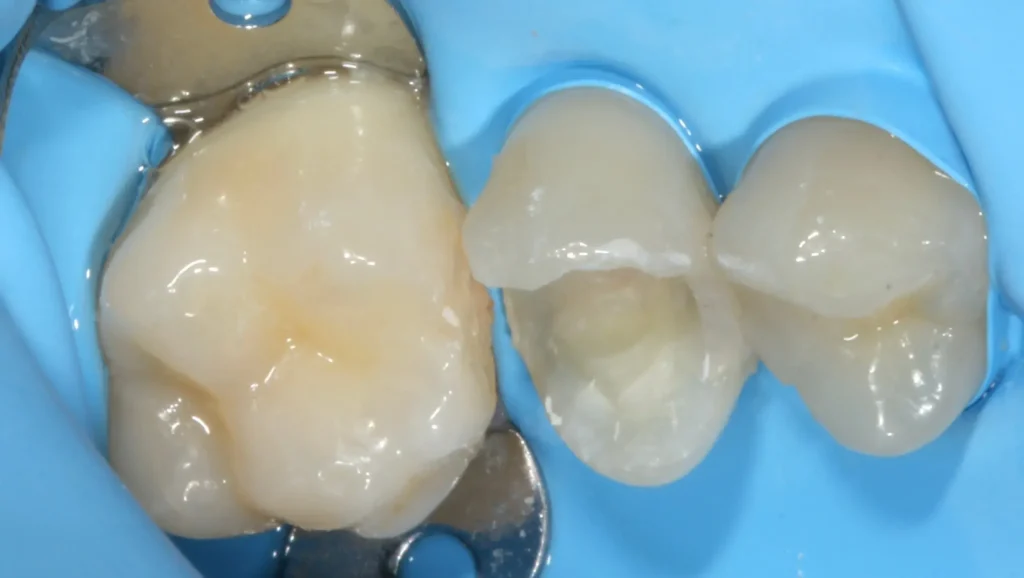 Antes y después restauración disilicato de litio