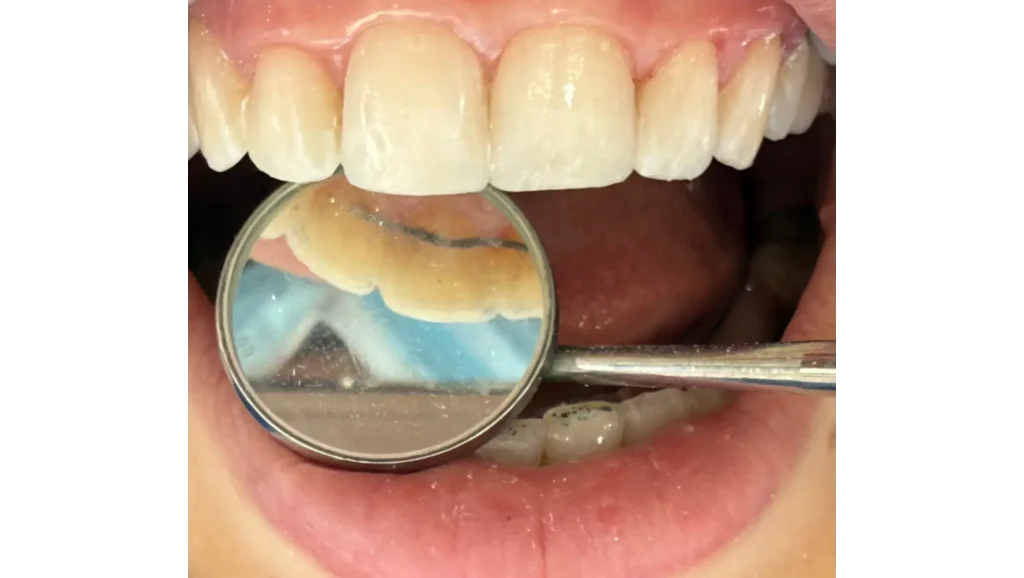 Restauración de caries