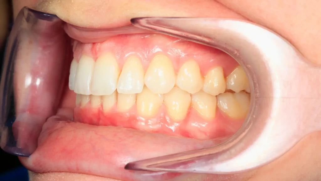 Ortodoncia antes y después desalineación