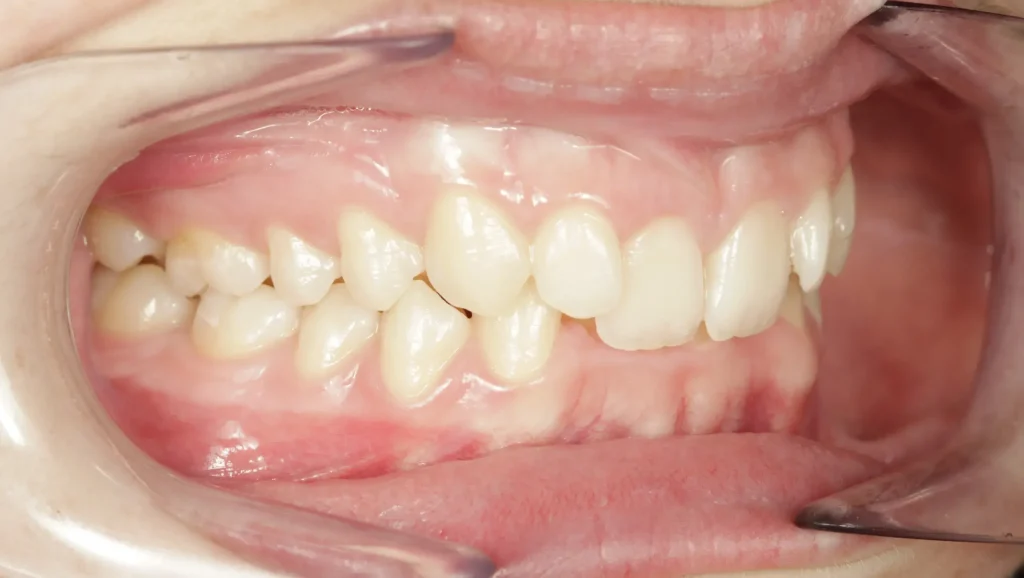 Ortodoncia antes y después mordida cruzada