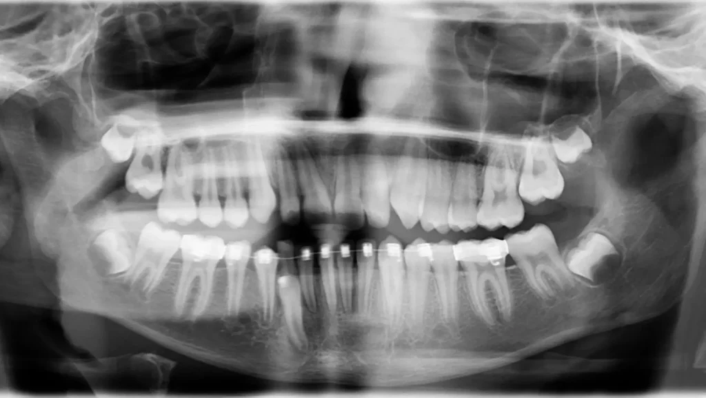 Ortodoncia antes y después canino inferior impactado