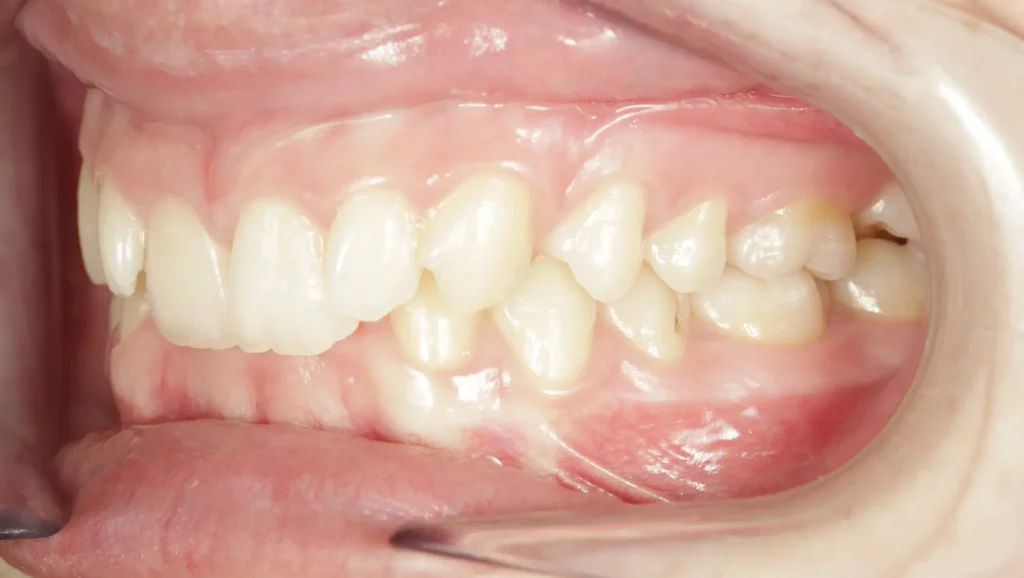 Ortodoncia antes y después mordida cruzada