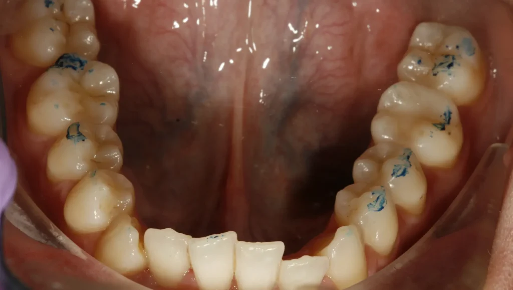 Ortodoncia antes y después Maloclusión