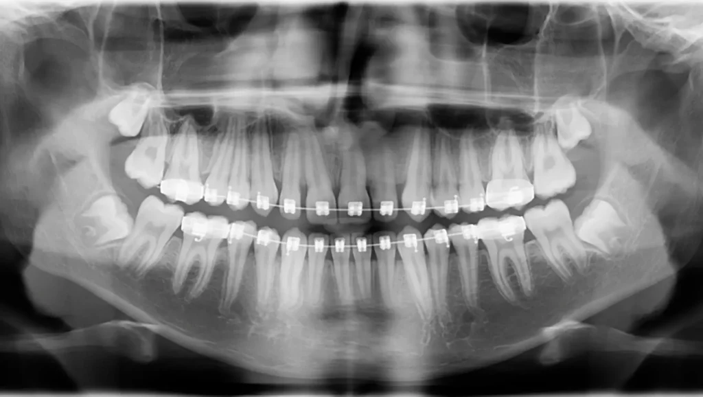 Ortodoncia antes y después canino inferior impactado