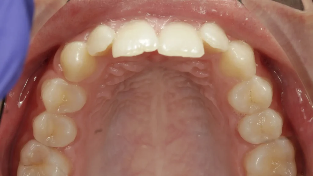 Ortodoncia antes y después mordida cruzada