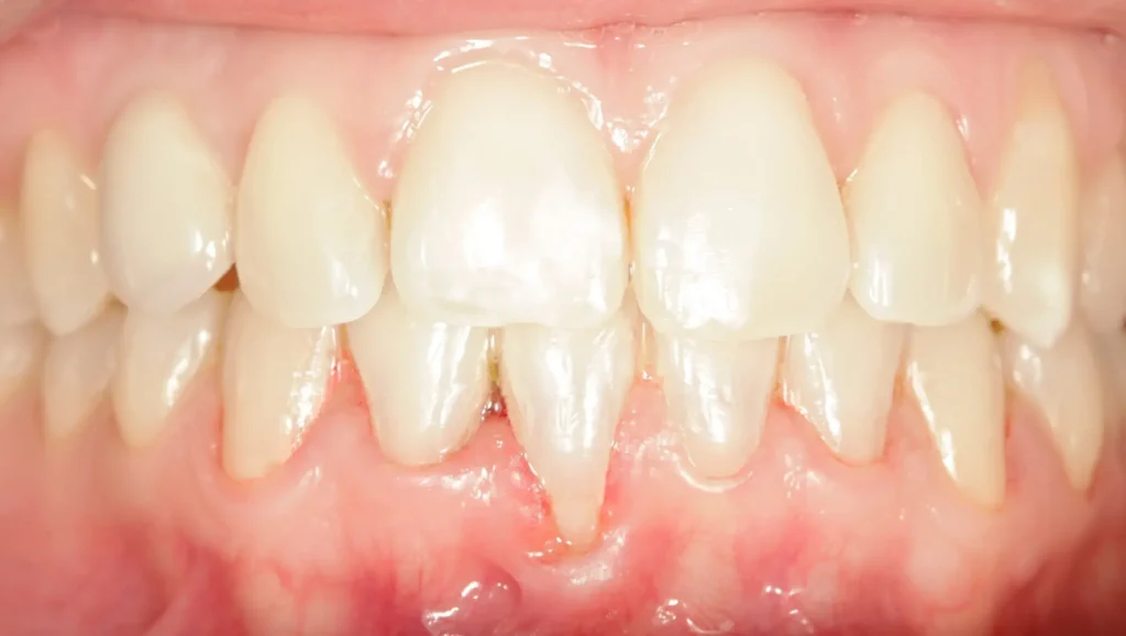 Cirugía mucogingival antes y después