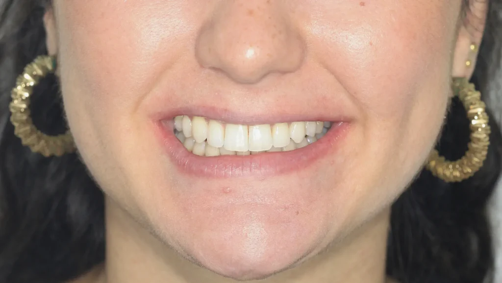 Ortodoncia antes y después desalineación