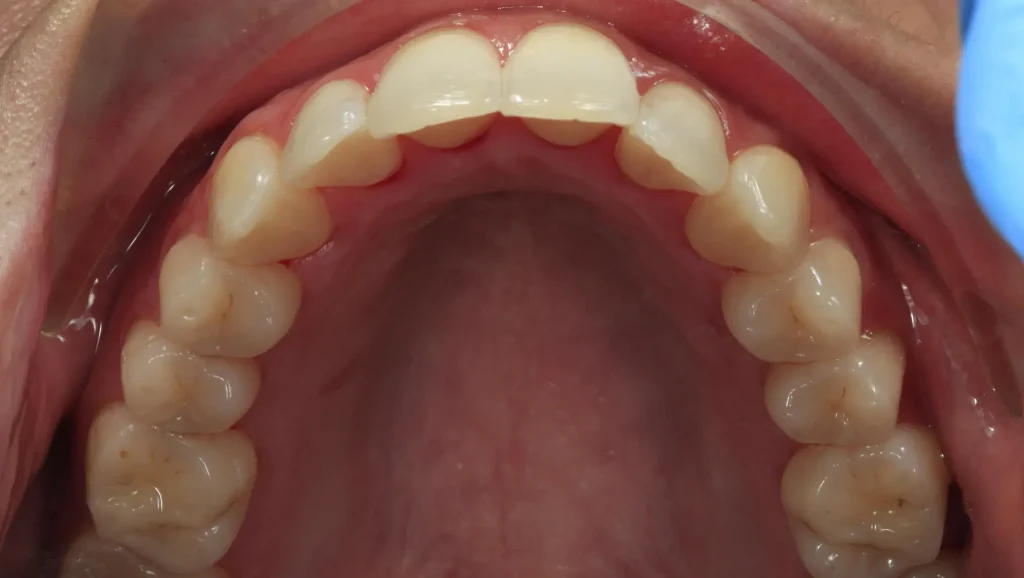Ortodoncia antes y después Maloclusión