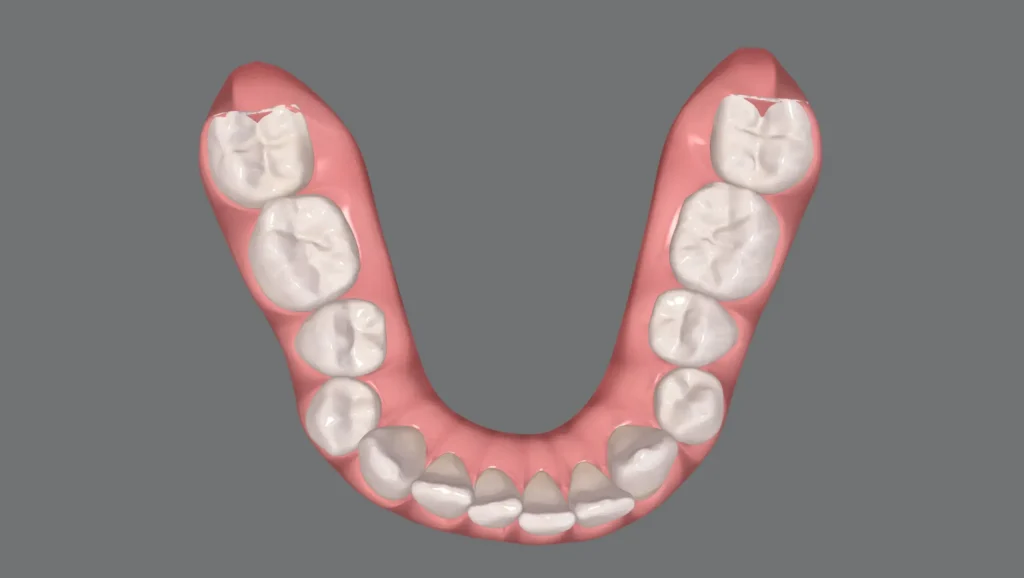 Ortodoncia antes y después desalineación