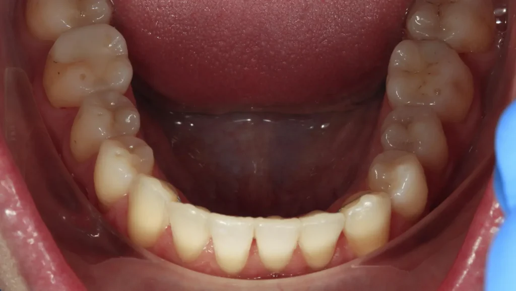 Ortodoncia antes y después Maloclusión