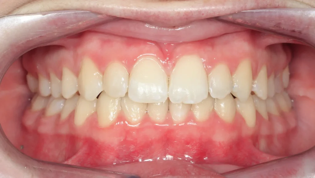 Caso 1 mordida cruzada