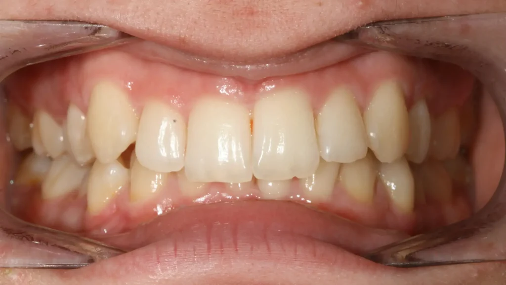 Ortodoncia antes y después desalineación