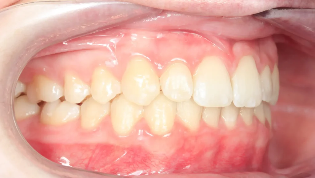 Caso 1 mordida cruzada