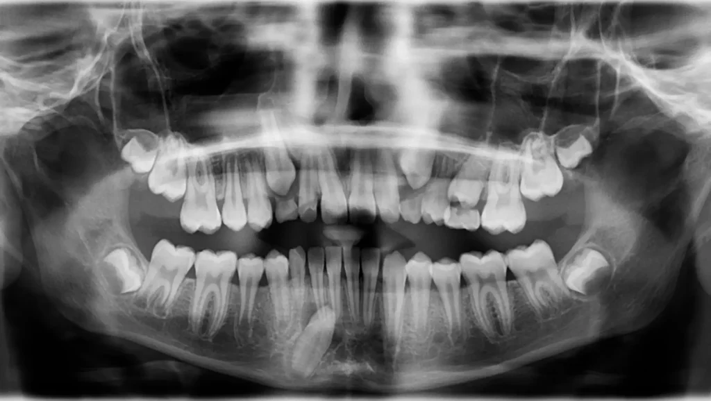 Ortodoncia antes y después canino inferior impactado