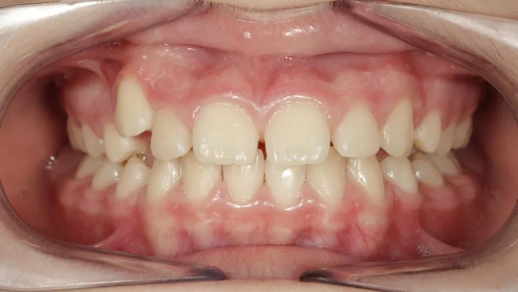Ortodoncia antes y después mordida cruzada